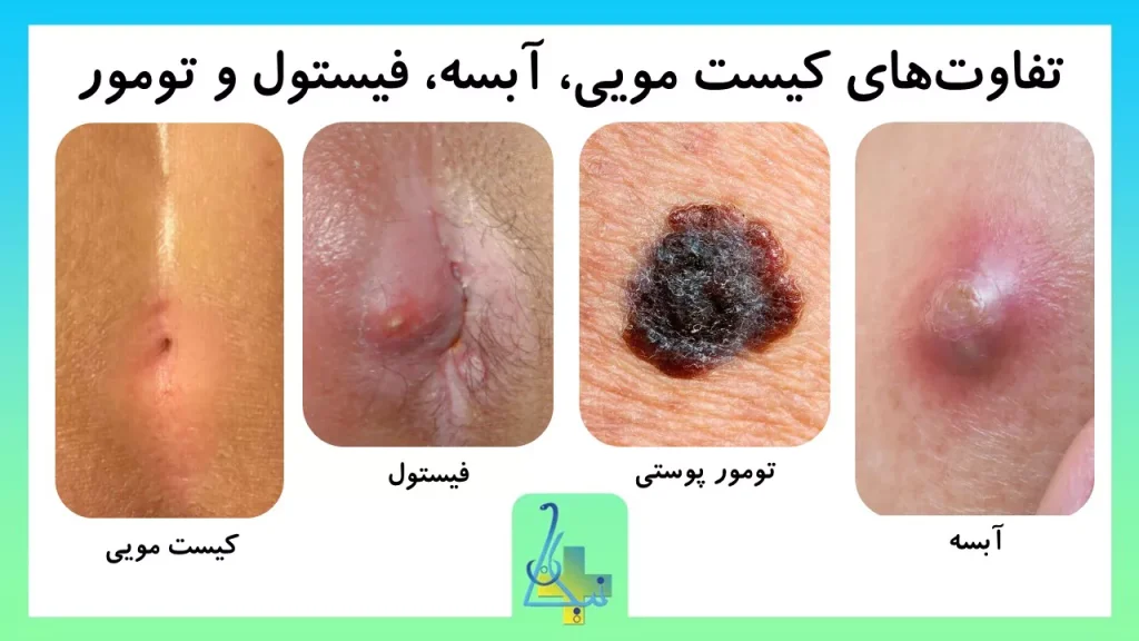 تفاوتهای کیست مویی، آبسه، فیستول و تومور