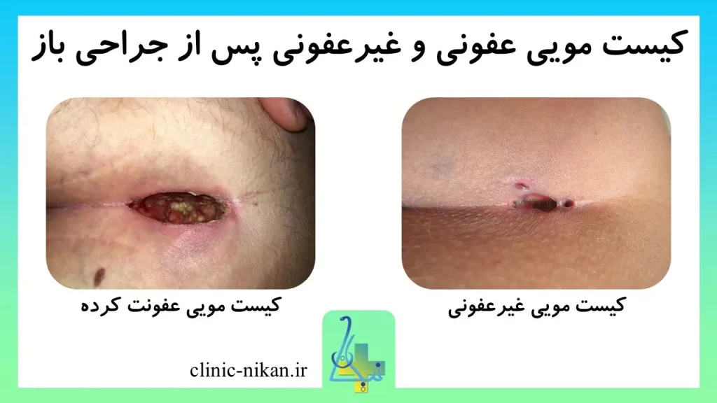 عکس کیست مویی عفونی و غیر عفونی پس از جراحی باز