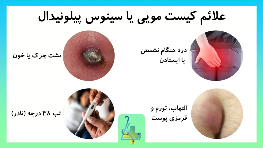 علائم کیست مویی