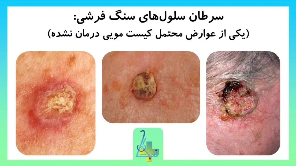 عوارض کیست مویی اگر درمان نشود