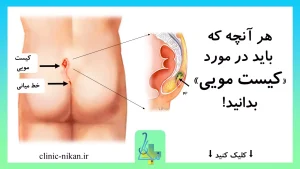 کیست مویی