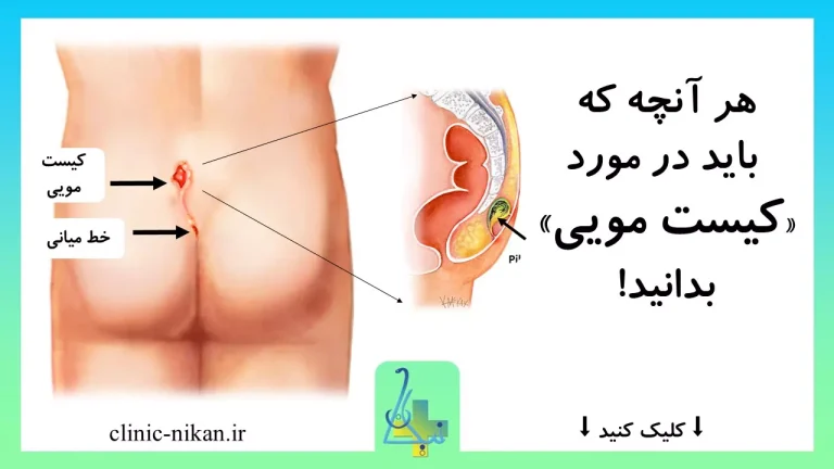 کیست مویی