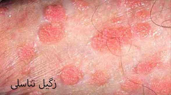 عکس زگیل تناسلی