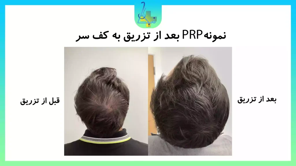 PRP عکس قبل و بعد پلاسما تراپی
