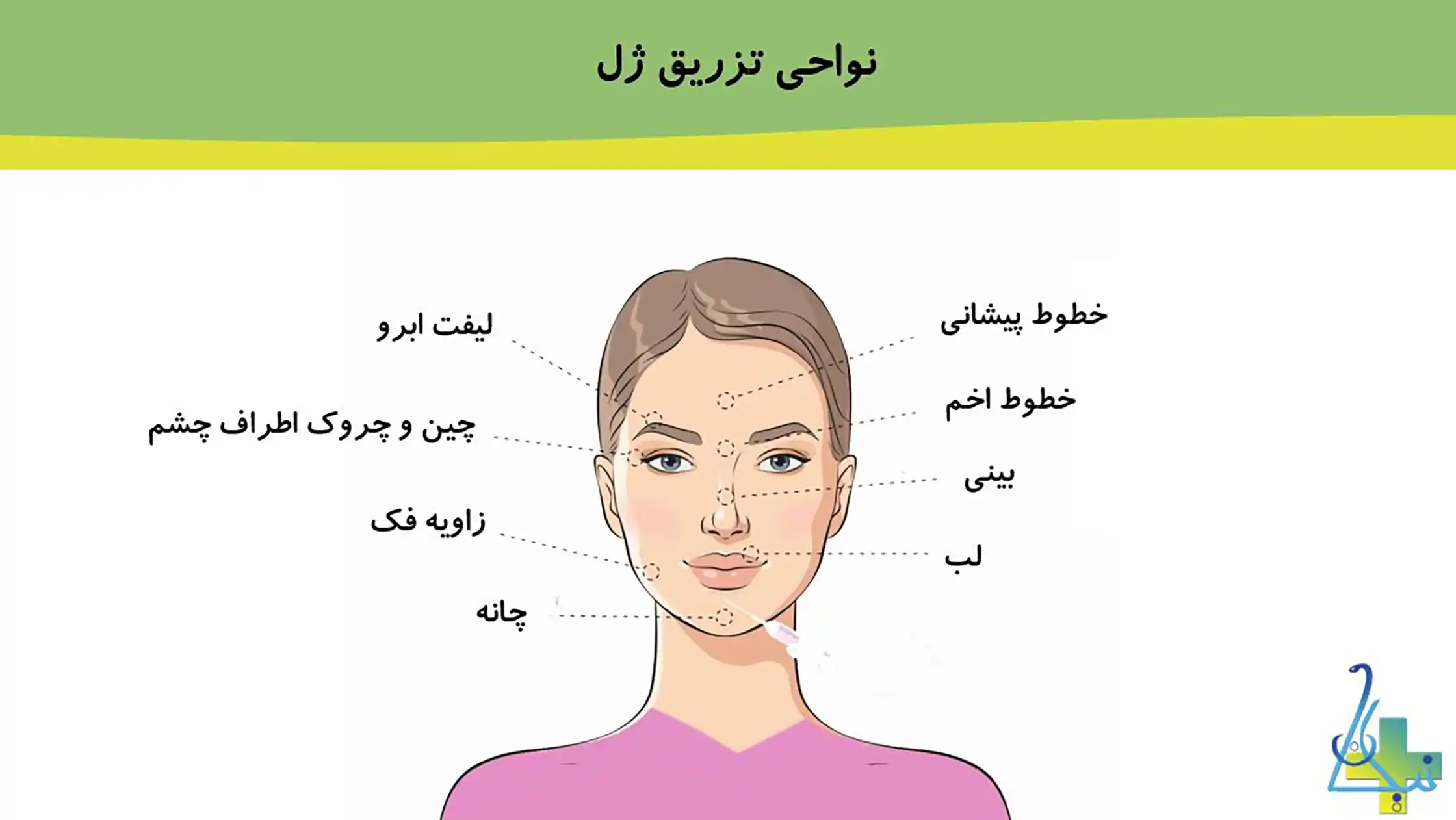 ژل صورت به کدام نواحی تزریق می‌شود؟
