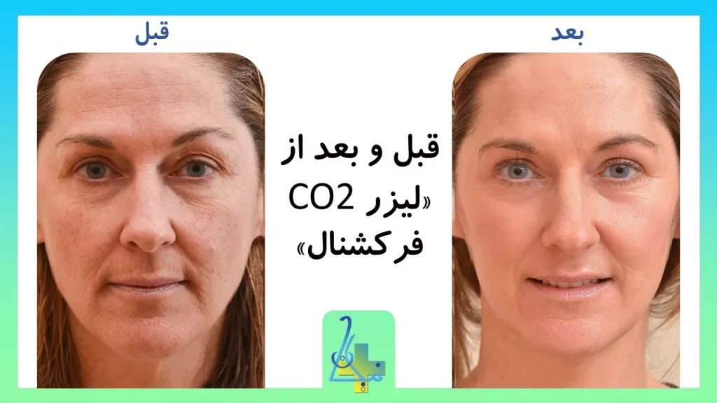 قبل و بعد لیزر Co2 فرکشنال
