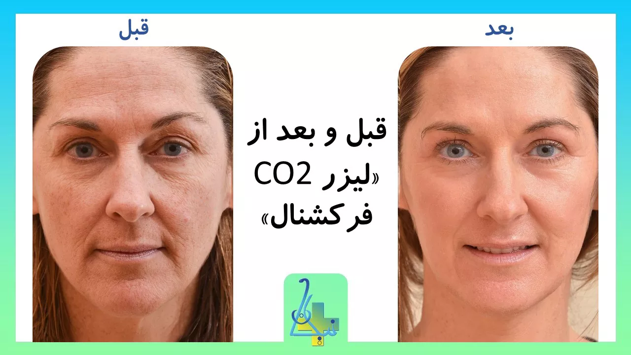قبل و بعد لیزر Co2 فرکشنال