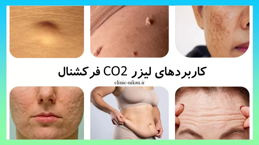 کاربردهای لیزر co2 فرکشنال