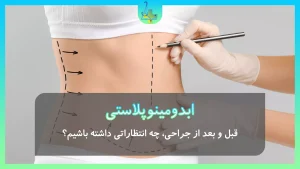 ابدومینوپلاستی( جراحی زیبایی شکم )