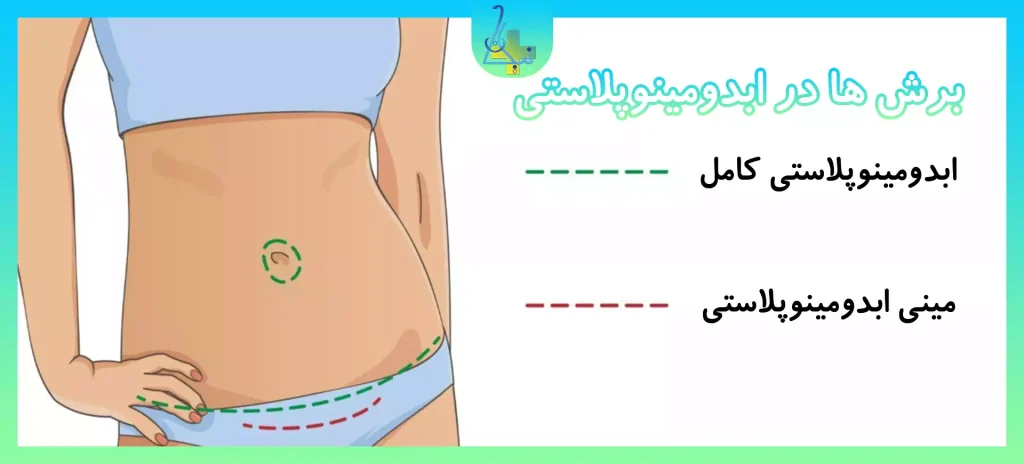 انواع برش ها در ابدومینوبلاستی