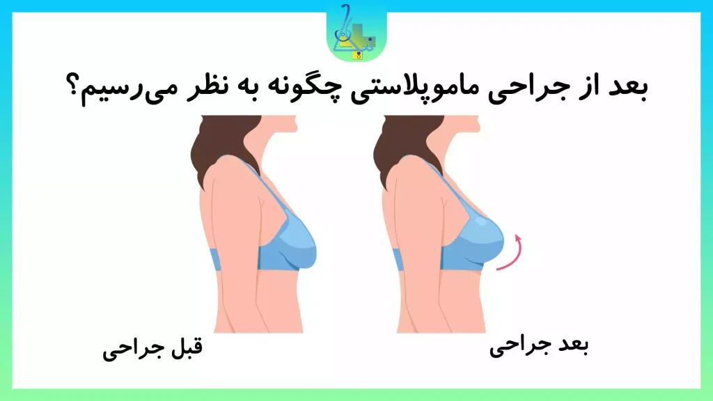 نتایج جراحی ماموپلاستی