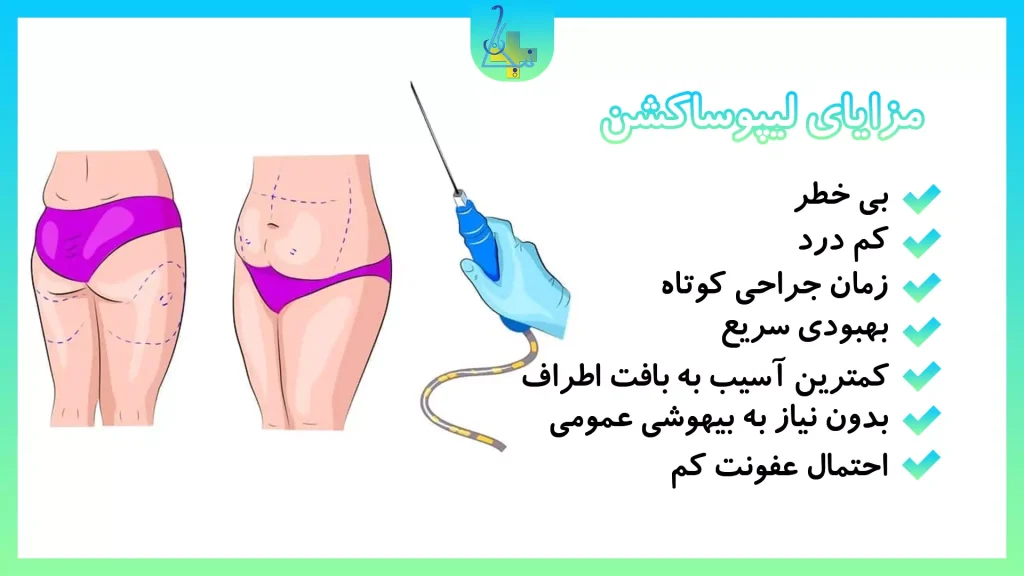 مزایای لیپوساکشن: