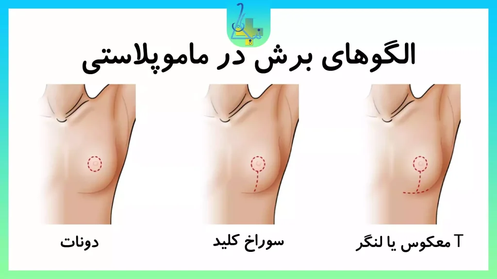 الگوهای برش در ماموپلاستی