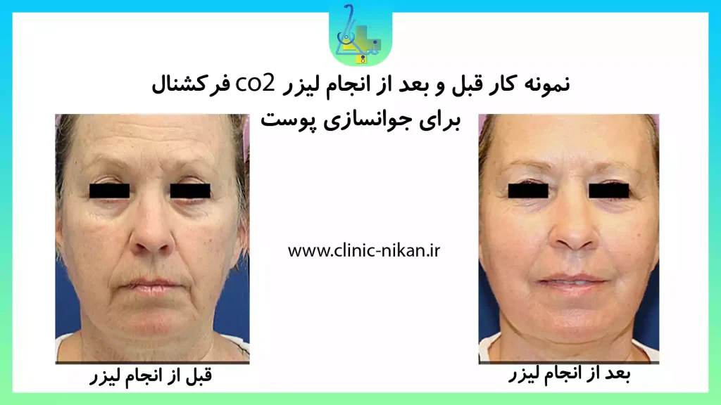 قبل و بعد لیزر co2