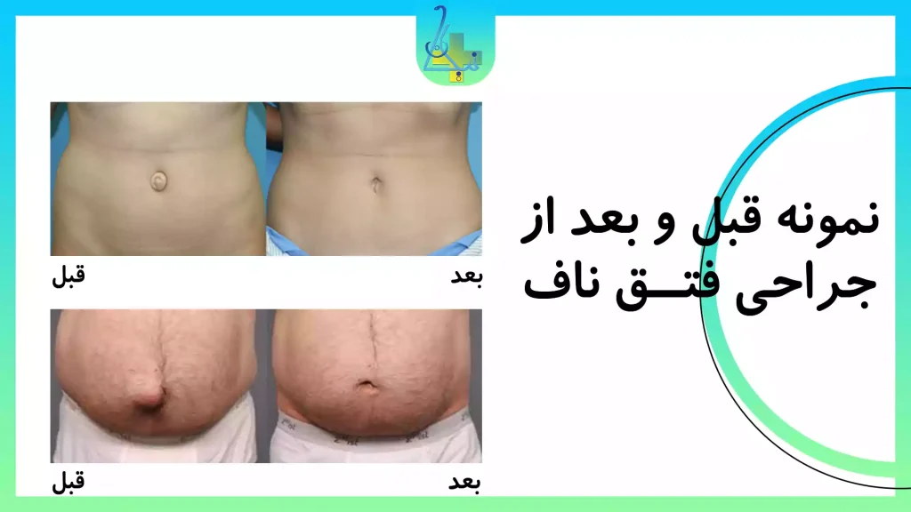 نمونه قبل و بعد از جراحی فتق ناف