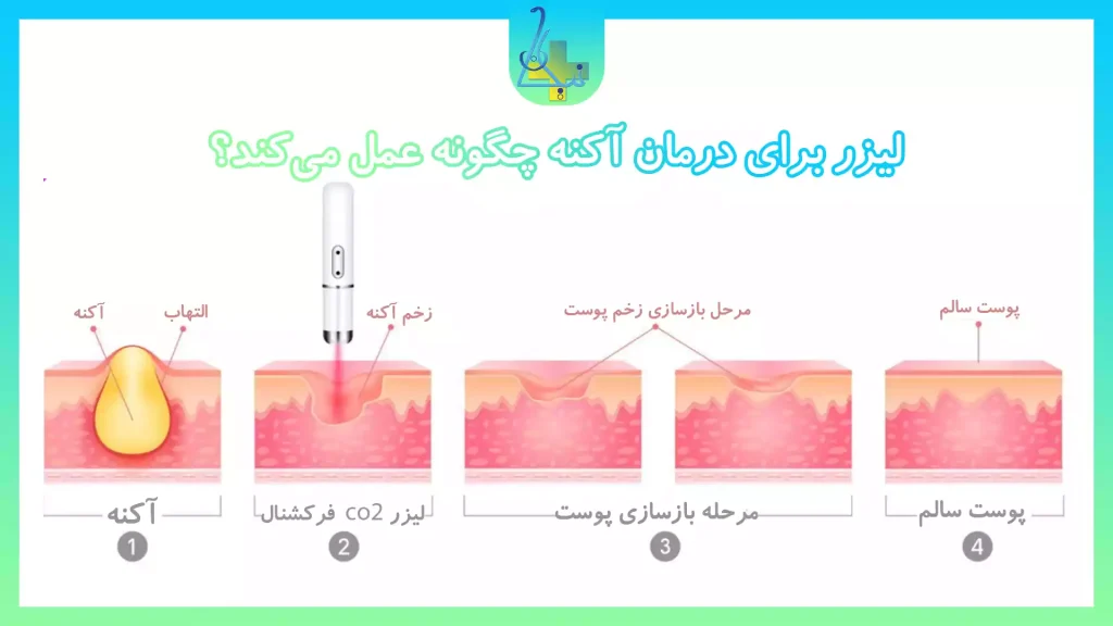 ذستگاه لیزر co2 برای آکنه چگونه عمل می‌کند؟