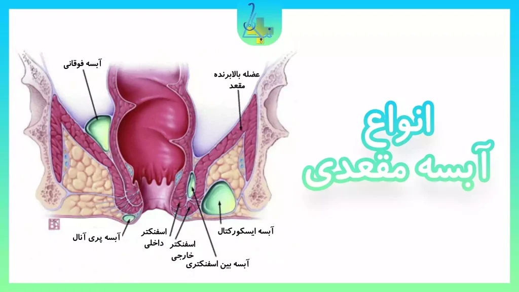 انواع آبسه مقعدی