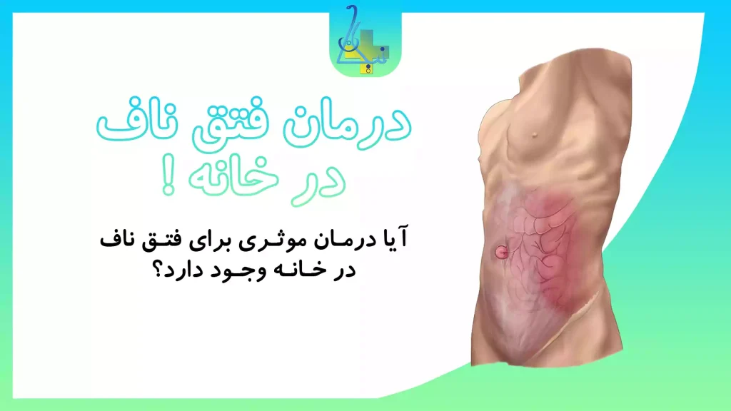 درمان خانگی فتق ناف