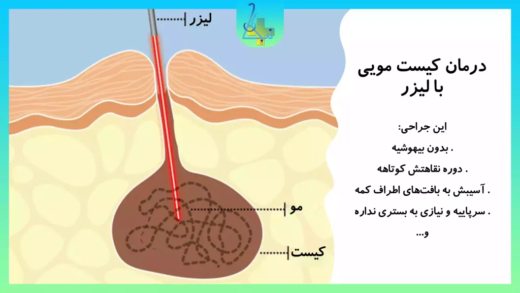 لیزر درمانی کیست مویی