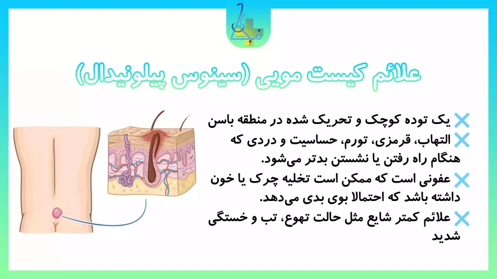 علائم کیست مویی (سینوس پینومیدال)