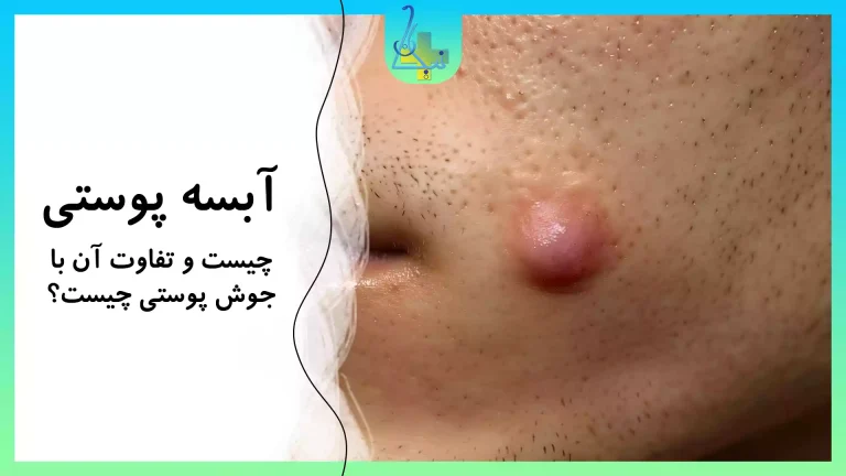 آبسه پوستی چیست؟