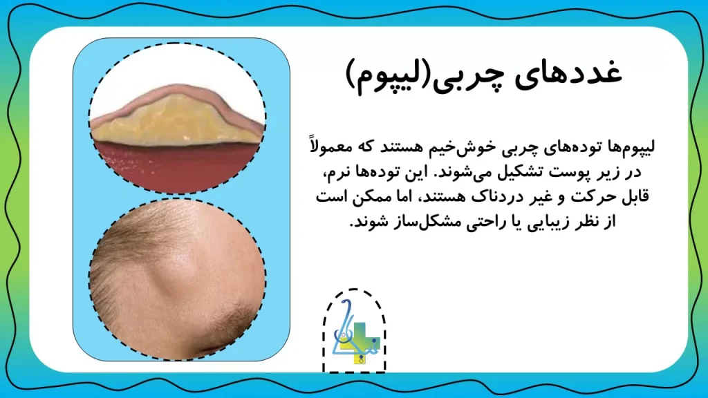 غده‌های چربی یا لیپوم چیست؟
