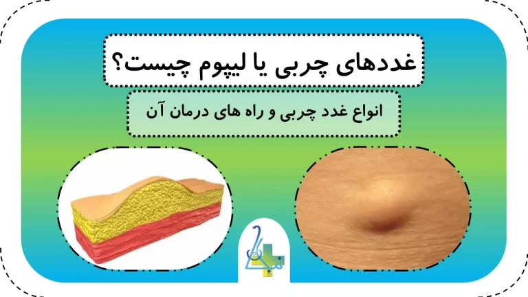  انواع غده‌های چربی یا لیپوم و راه‌های درمان آن