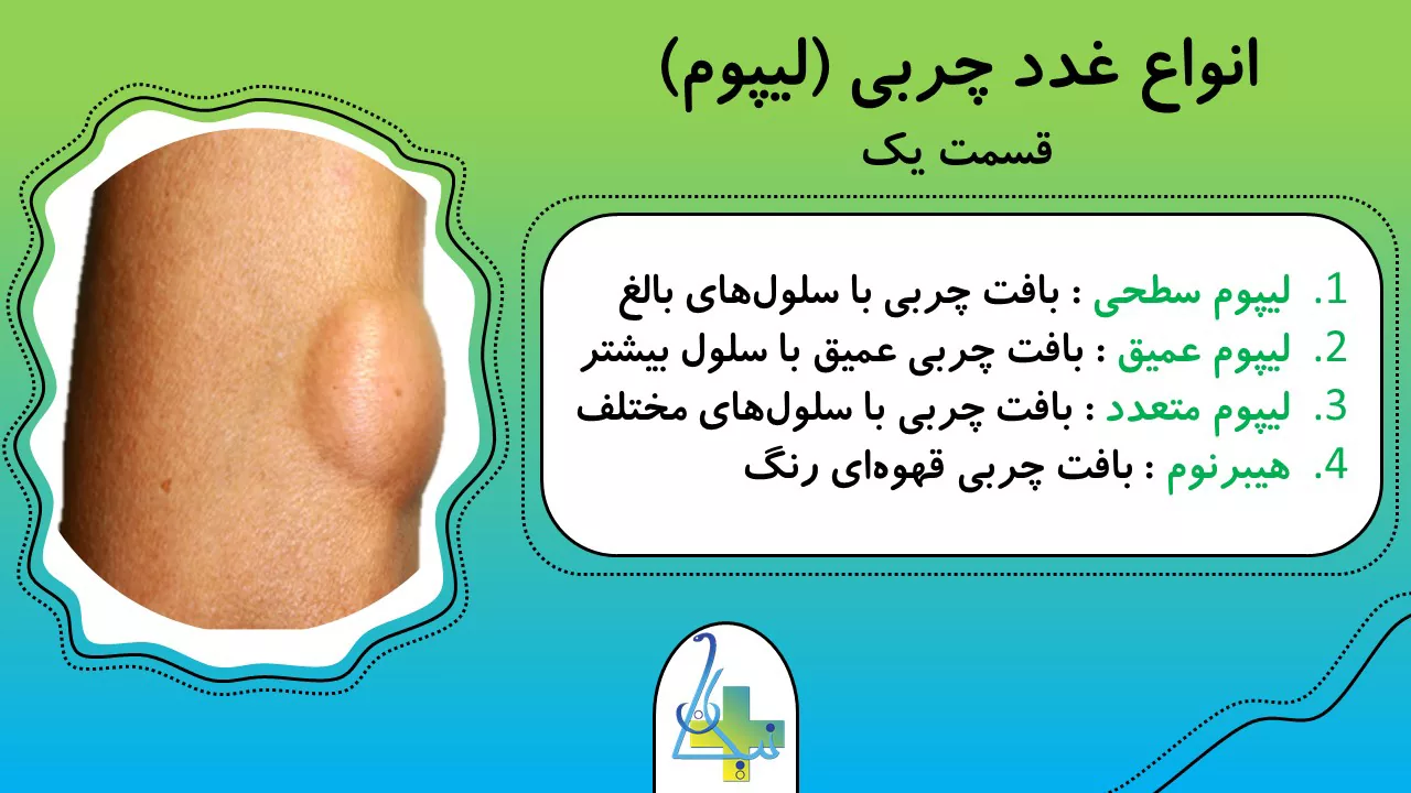 انواع غده‌های چربی یا لیپوم