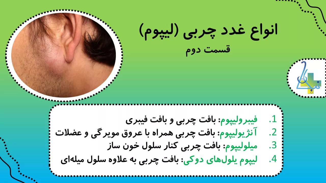 انواع غده‌های چربی یا لیپوم