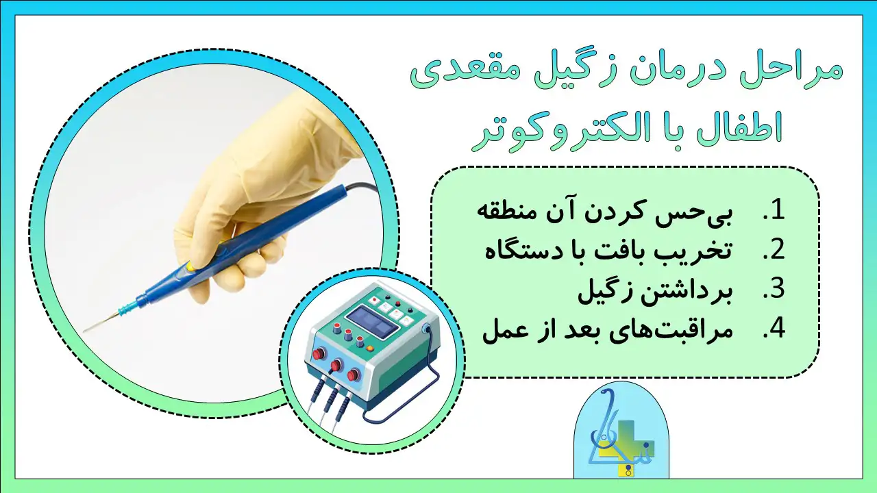 مراحل درمان زگیل مقعدی کودکان با الکتروکوتد چیست؟