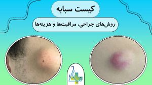 روش‌های جراحی کیست‌های سباسه ( مراقبت‌ها، هزینه‌ها)
