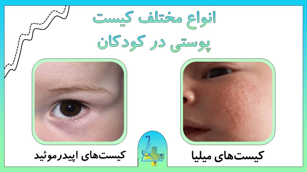 انواع مختلف کیست پوستی در کودکان