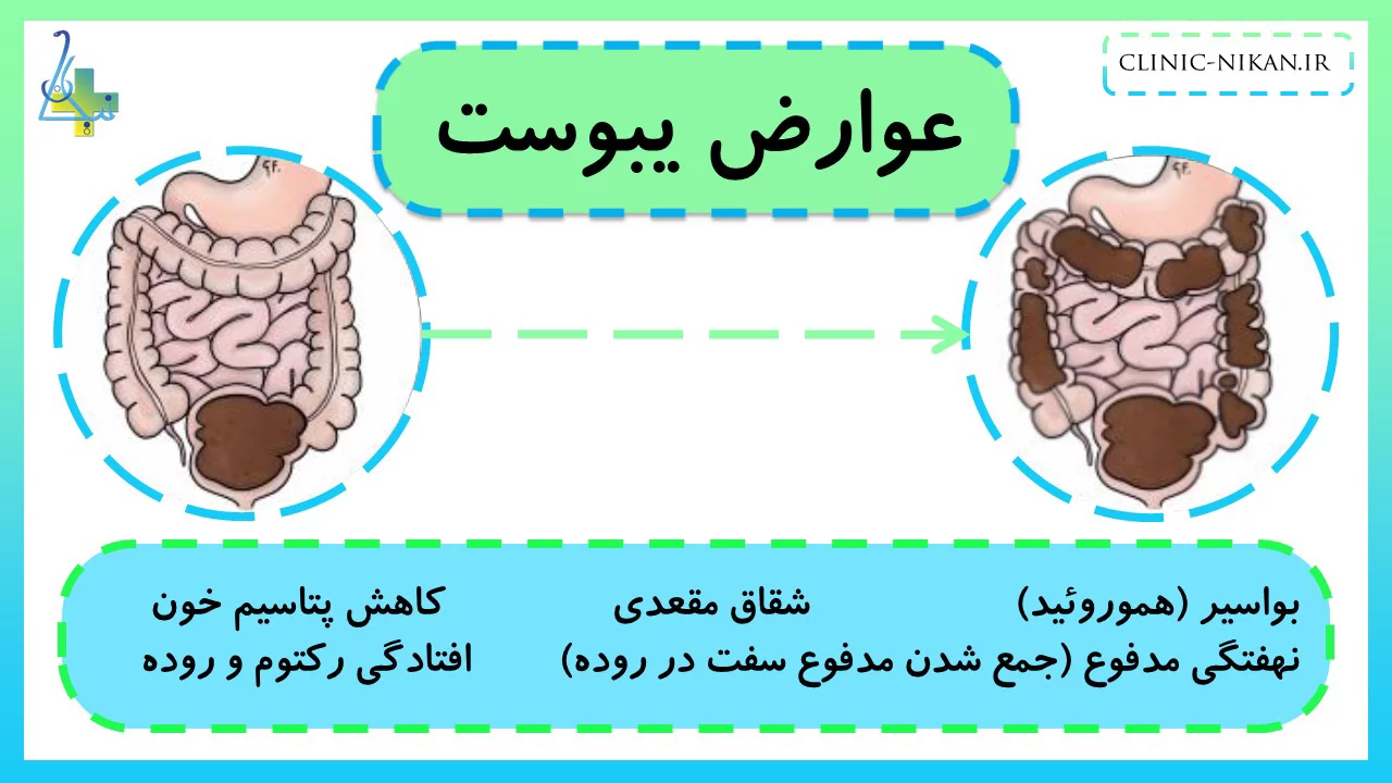 عوارض یبوست مزمن و طولانی مدت