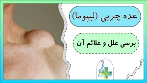 بررسی علل و علائم شایع غده چربی (لیپوما)