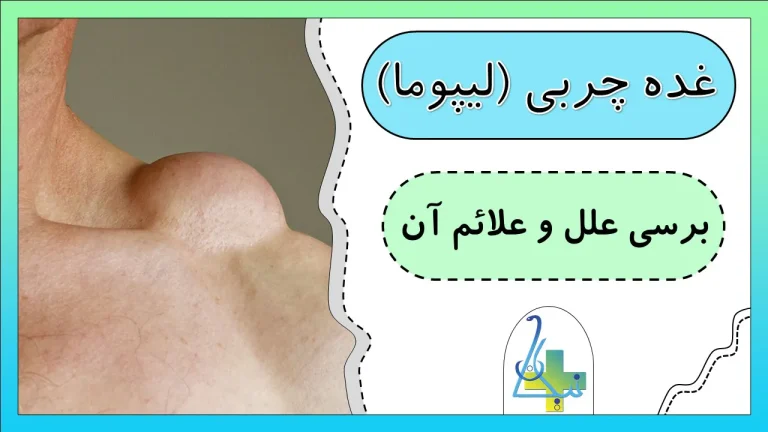 بررسی علل و علائم شایع غده چربی (لیپوما)