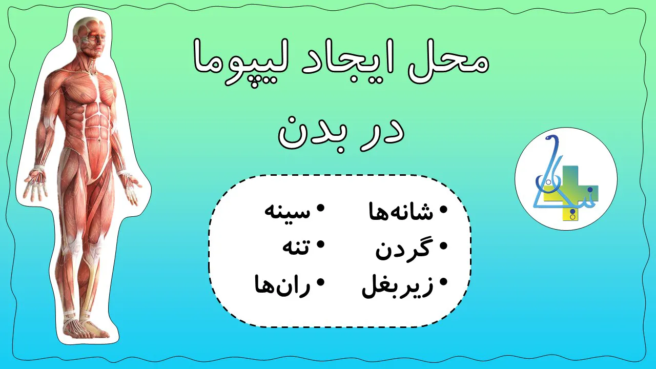 محل ایجاد غده چربی (لیپوما) در بدن