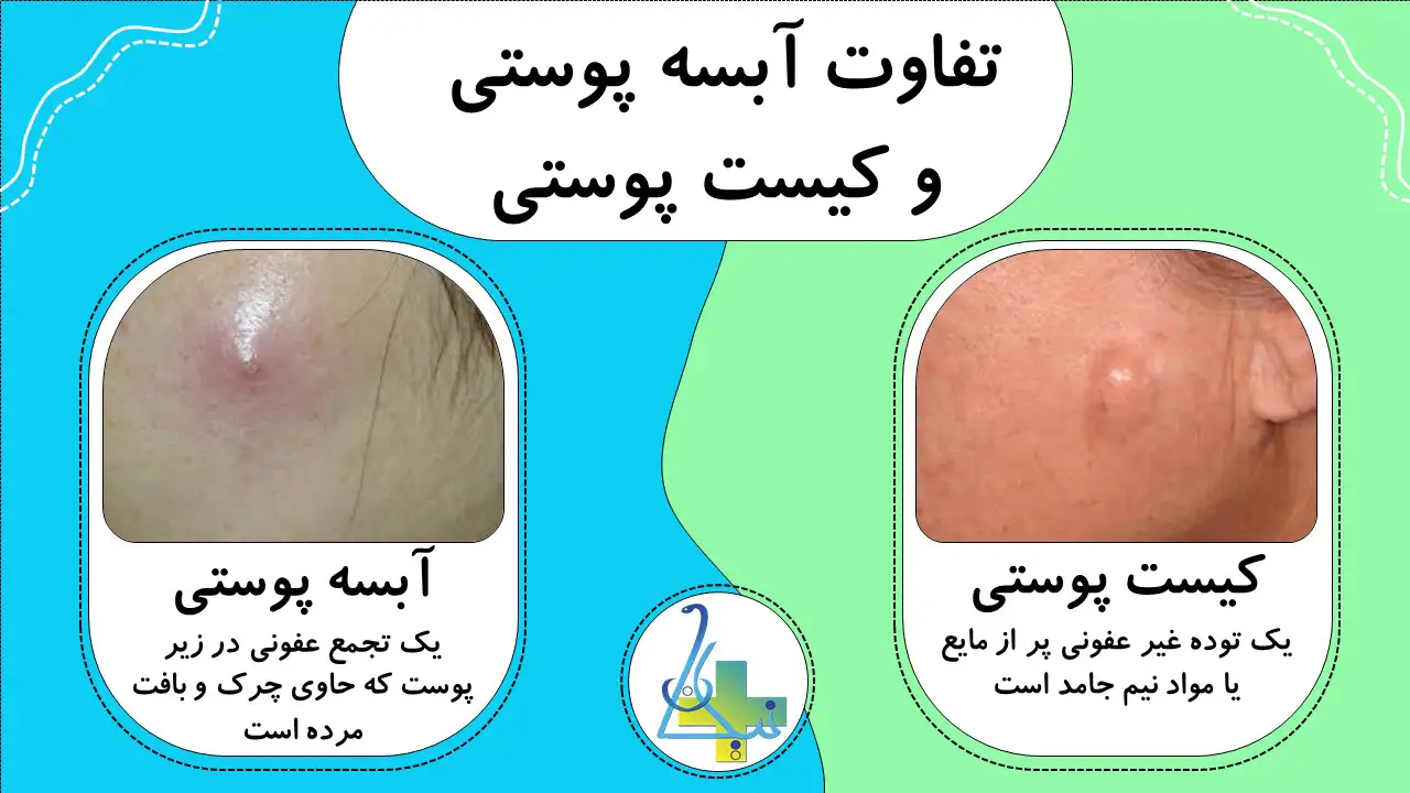 تفاوت آبسه پوستی با کیست پوستی چیست؟