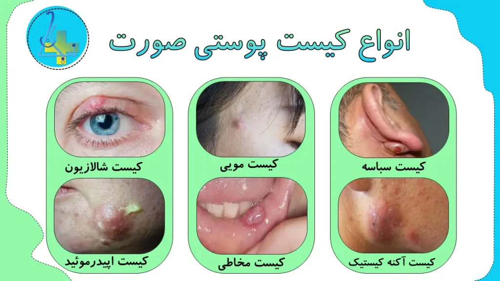 انواع کیست پوستی در صورت