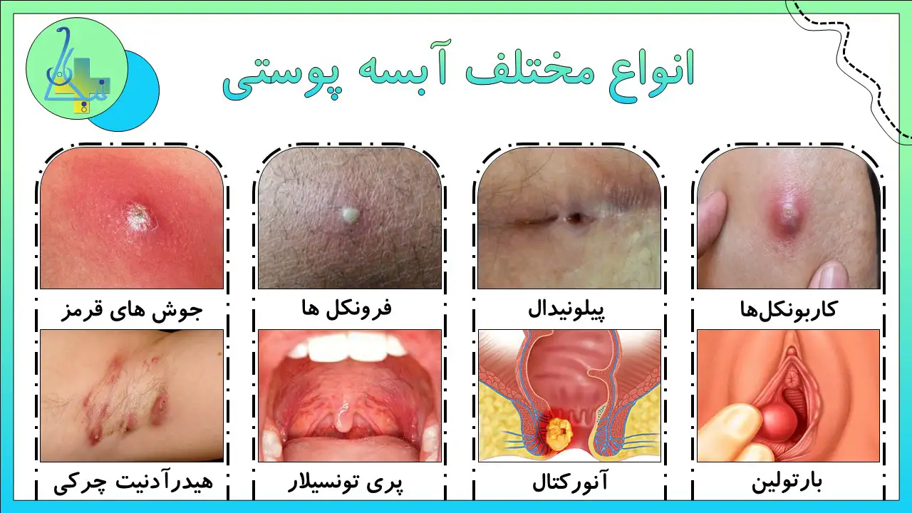 انواع مختلف آبسه پوستی