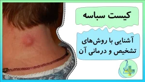 انواع کیست سباسه و راههای درمان آن