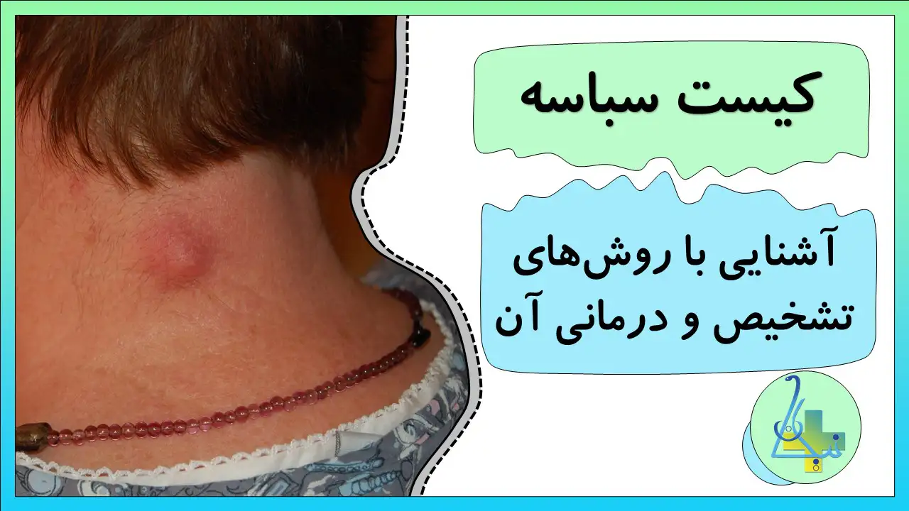 انواع کیست سباسه و راههای درمان آن