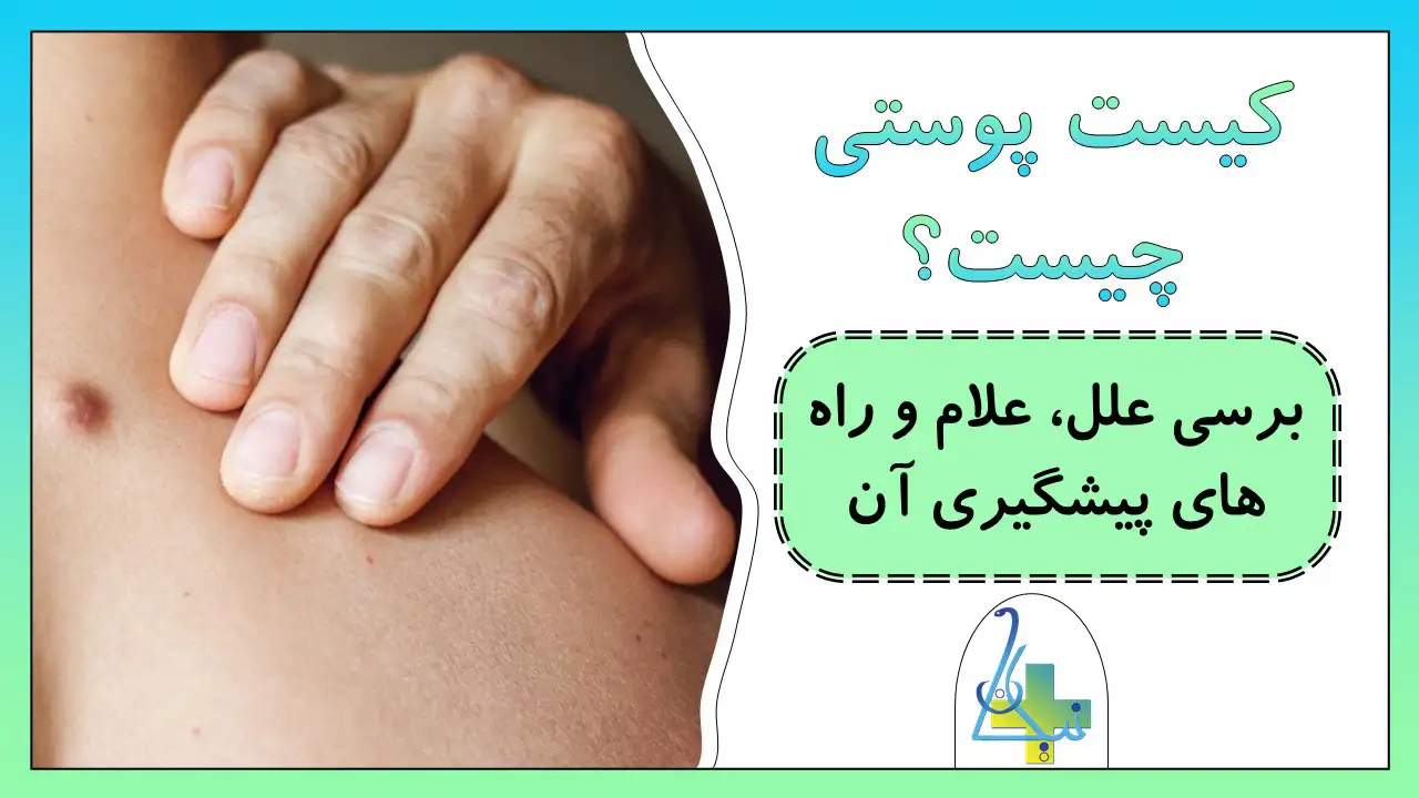 کیست پوستی چیست؟ بررسی علل و علائم کیست پوستی