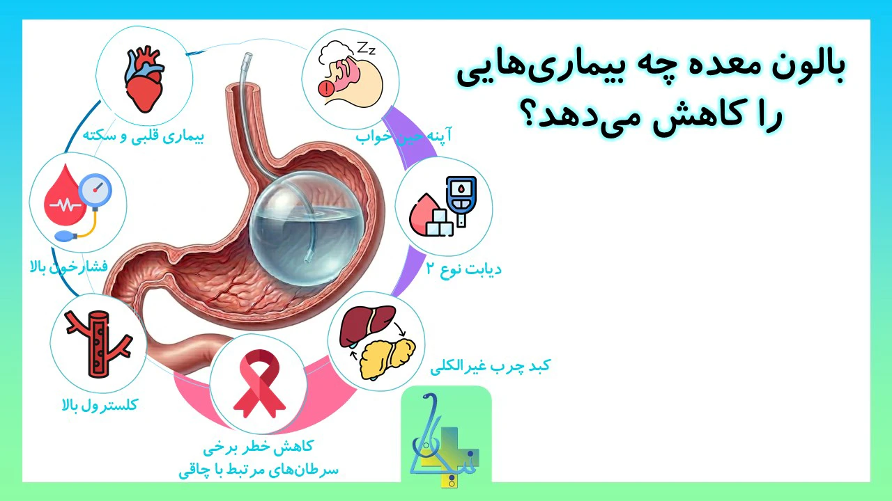 بالون معده چه بیماری‌هایی را کاهش می‌دهد؟