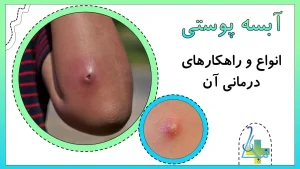 انواع آبسه پوستی و راهکارهای درمان آن
