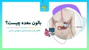 بالون معده، کاهش وزن بدون جراحی